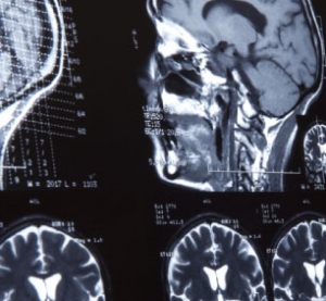Profile Image of Brain Injuries